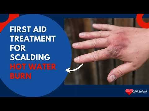 First Aid Treatment for Scalding Hot Water Burn