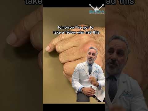 Don't ignore a finger fracture! Dr.Badia Explains why you should see a specialist
