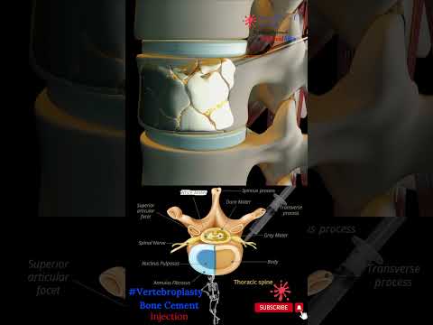 Bone Cement Injection - Vertebroplasty - Percutaneous Vertebral Augmentation - Spinal Cement