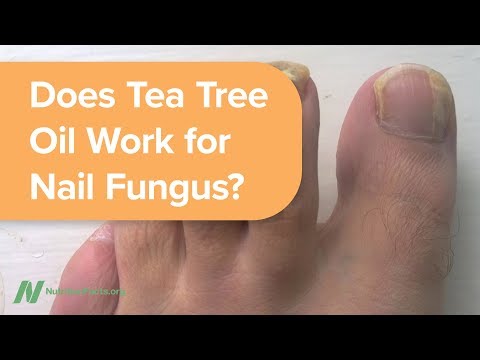 Does Tea Tree Oil Work for Nail Fungus?