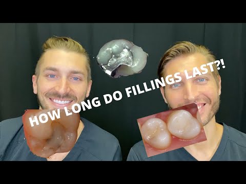 How Long Do Fillings Last?